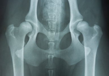 X-Ray of hips